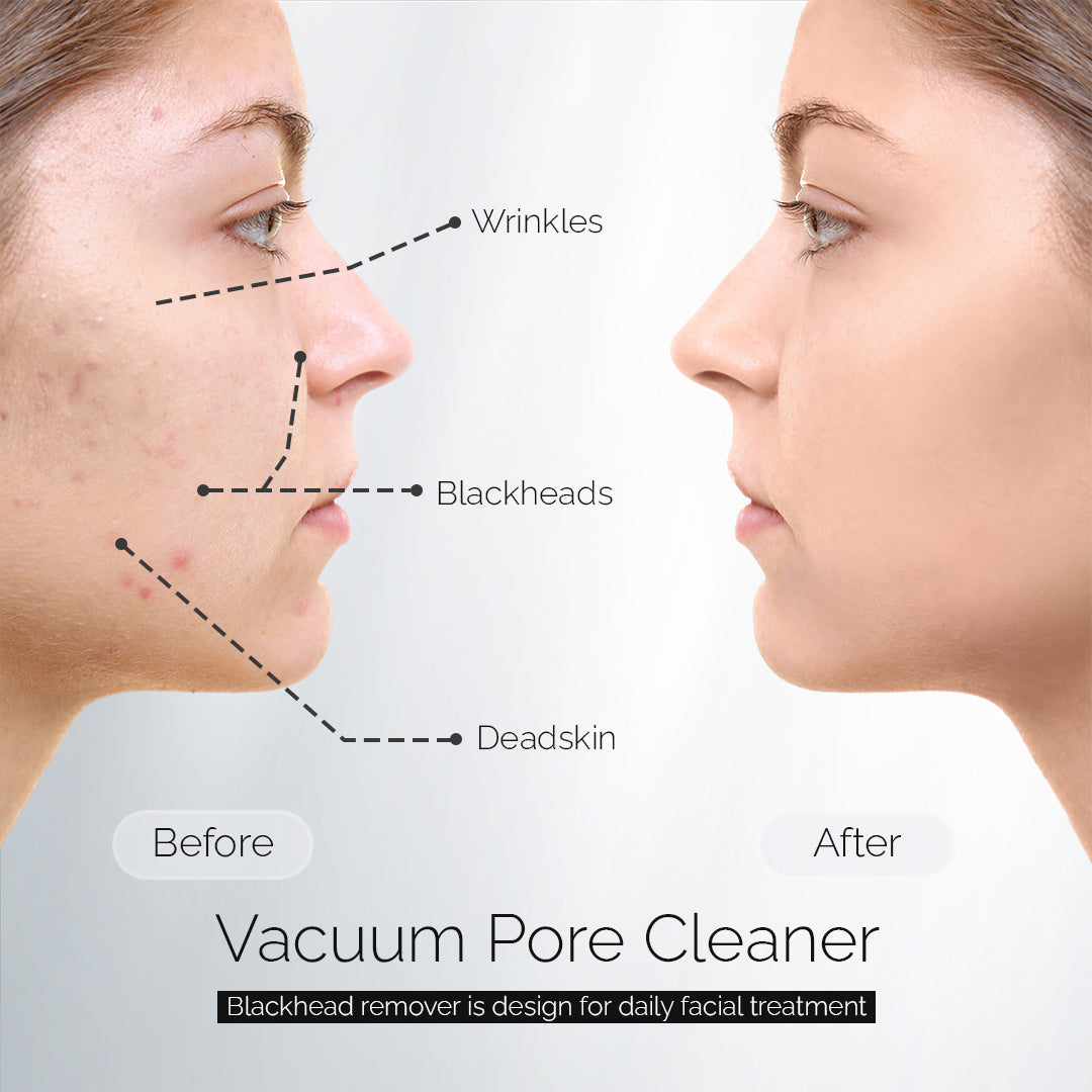 Blackhead Remover Vacuum Suction Pore Cleaner